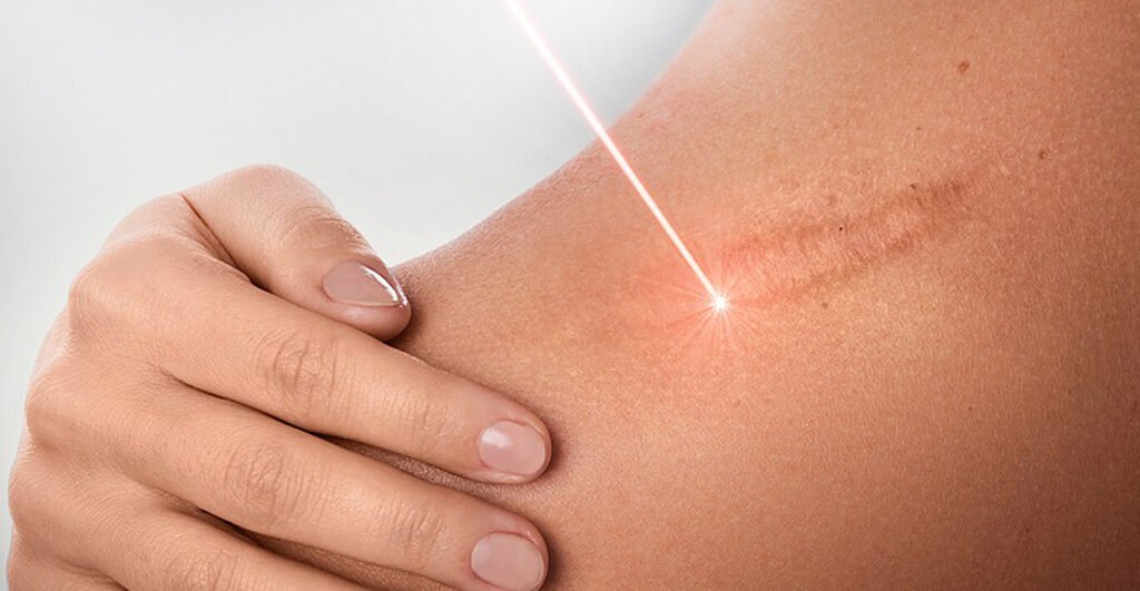 Лазерное удаление рубцов в Медиостар: комфорт, безопасность и отличный результат