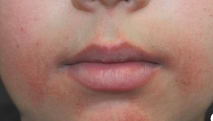 Сыпь вокруг рта: периоральный дерматит у детей и женщин. Советы дерматолога